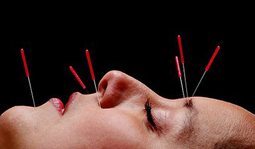 A Little Bit About The Benefits of Facial Acupuncture