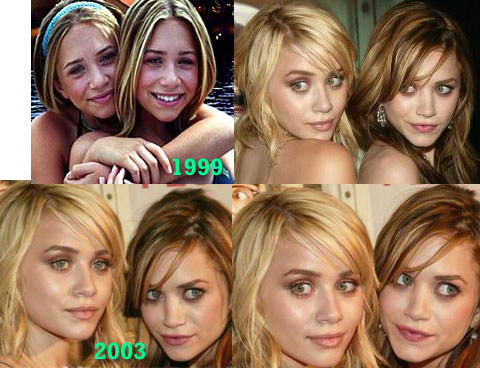 Marky Kate & Ashley Nose Job