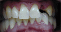 I Need A New Tooth!