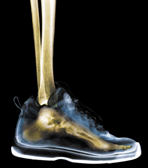 5 Things: That Affect Your Bone Density