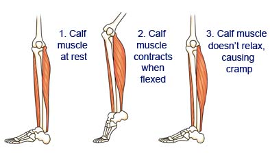 The Skinny On: Muscle Cramps