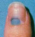 How Long Will It Take A Mark To Grow Out Of Your Nail?