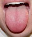 Got a Bumpy Tongue?